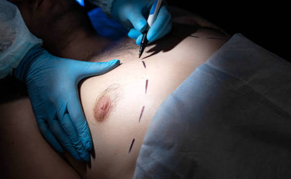 Best Male Breast Surgeon in Kalyan,Dombivli