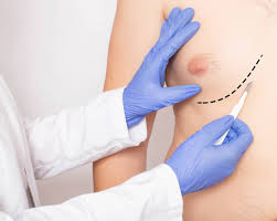 Best Treatment For Male Breast Surgery in Dombivli